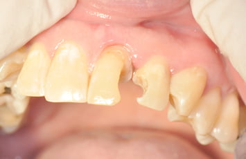 前牙缺損